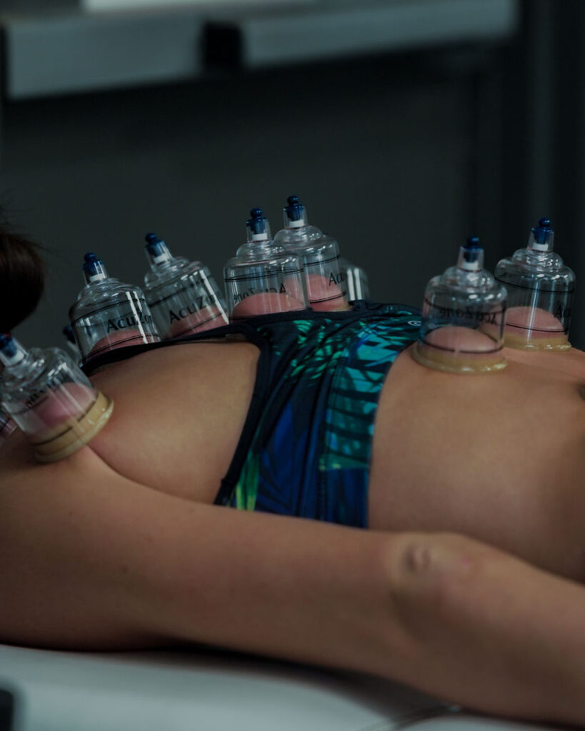 Cupping Therapy at MOVE